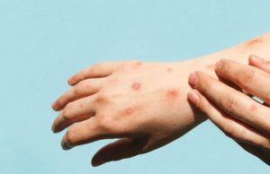 ¿Hay riesgo de contagio de viruela símica en Cundinamarca? ¿Hay riesgo de contagio de viruela símica en Cundinamarca?