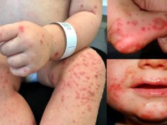 Alerta por propagación del virus Coxsackie