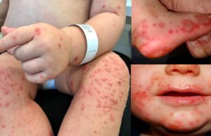 Alerta por propagación del virus Coxsackie