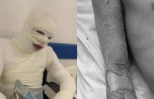 Recluso terminó gravemente quemado en Cundinamarca